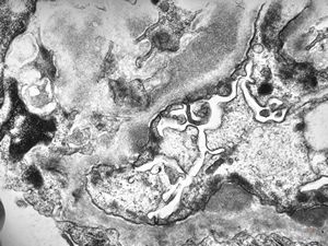 M,53y. | type III membranoproliferative glomerulonephritis M,53y. | type III membranoproliferative glomerulonephritis